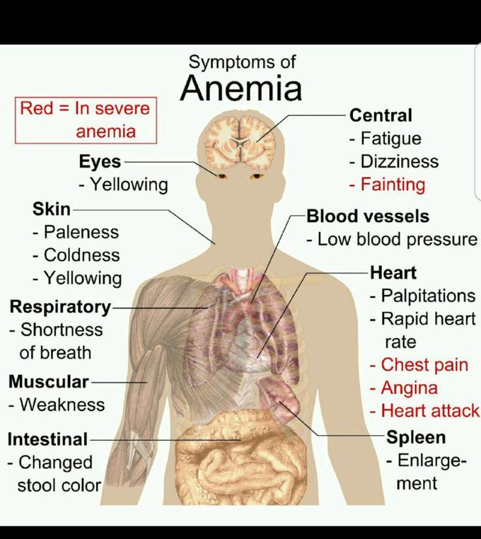 Anemia