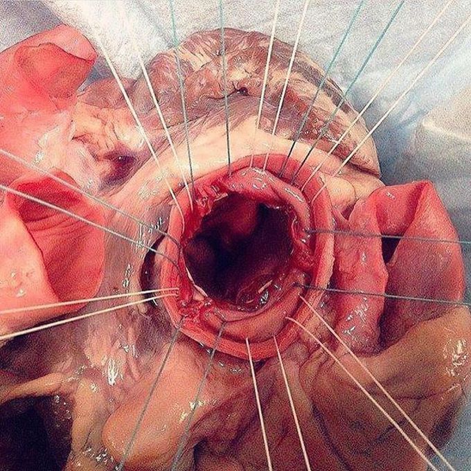 The aorta!!