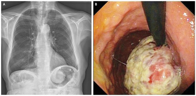 Gastric Cancer in Chest Radiograph