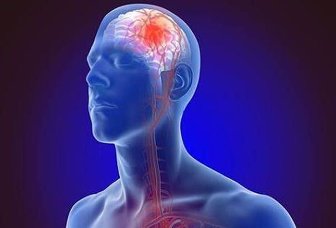What is stroke? Risk factors and Sign and symptoms.