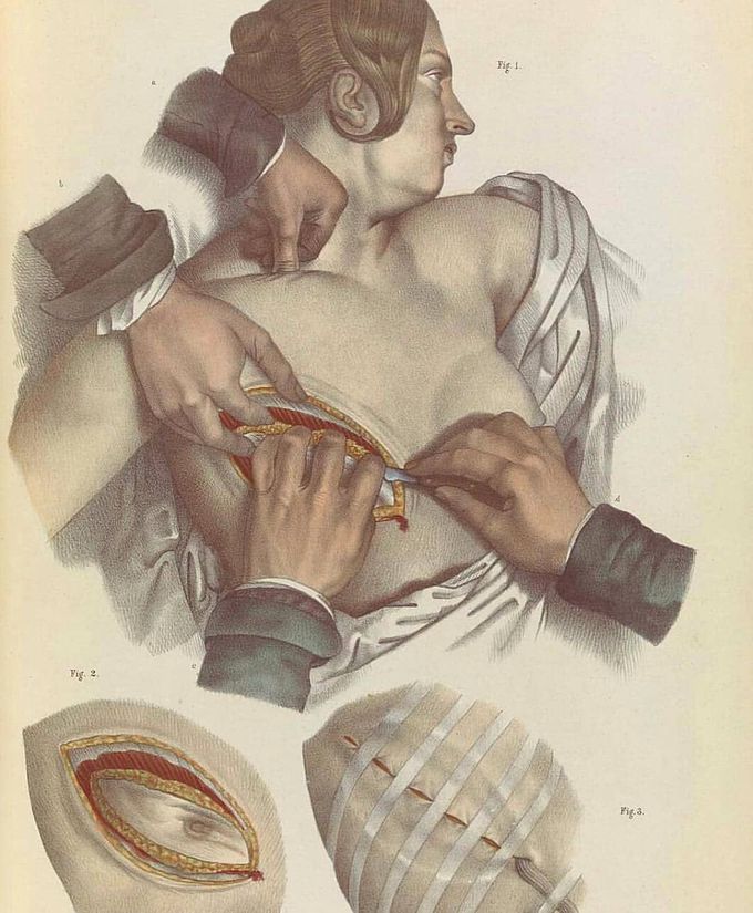 Mastectomy