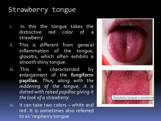 Strawberry Tongueraspberry Tongue Seen In Scarlet Fever Medizzy