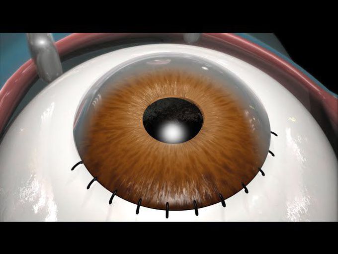Cataract Surgery-Animation
