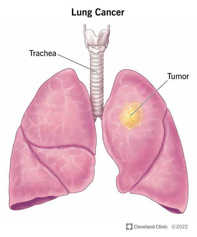 Lung Carcinoma