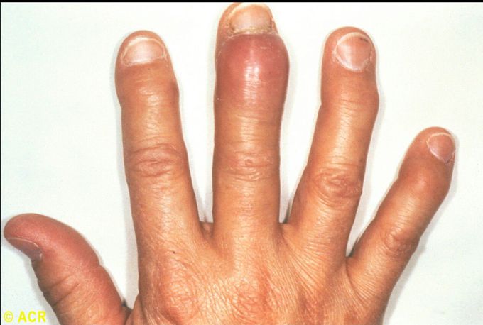 What's the name of this DIP nodes in osteoarthritis?!!