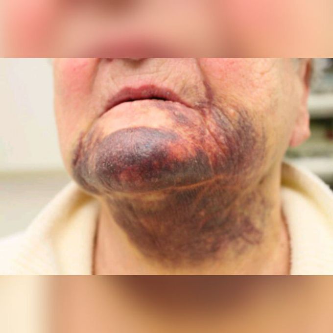 What is the diagnosis?