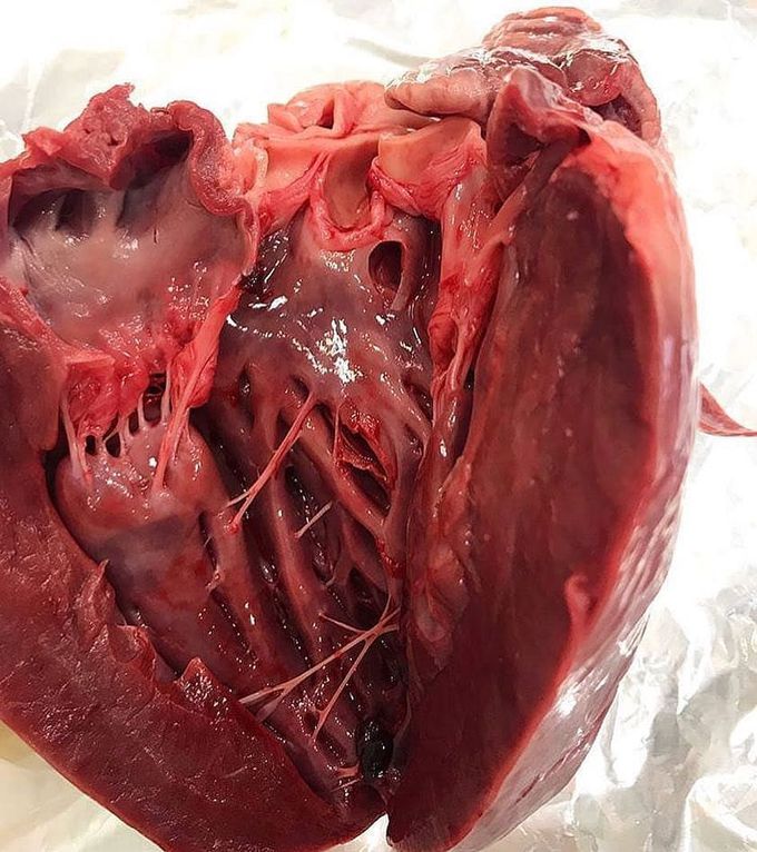 Hypertrophic cardiomyopathy