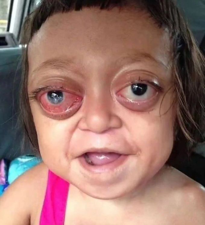 Crouzon Syndrome