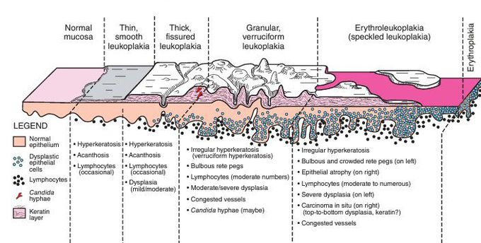 Leukoplakia