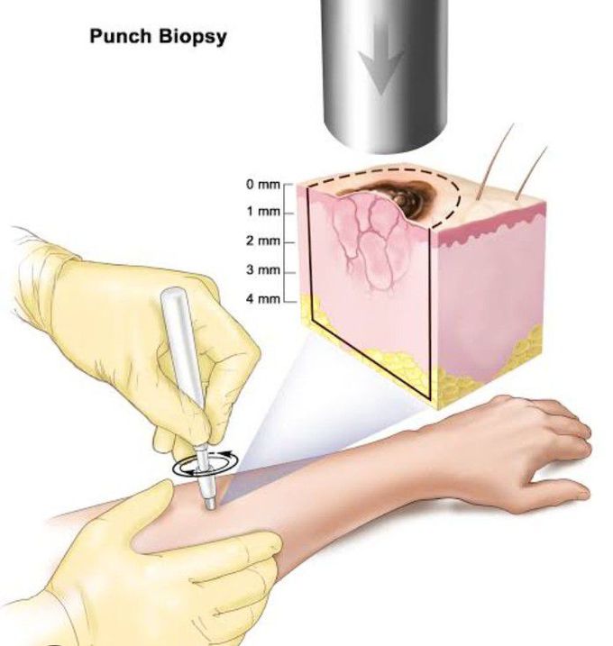 Treatment for Melanoma