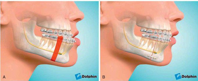 Mandibular ostectomy