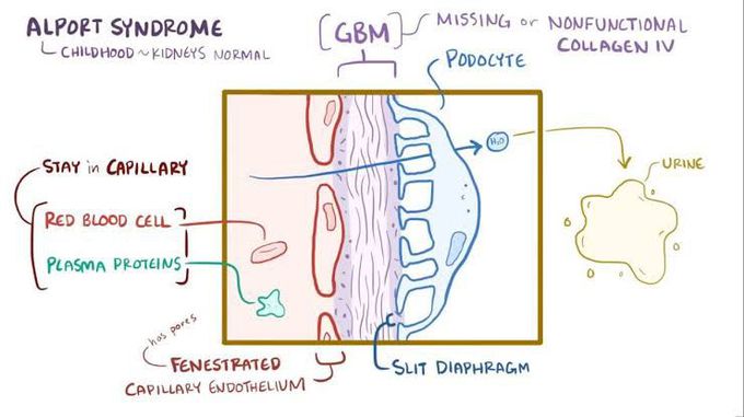 Alport syndrome