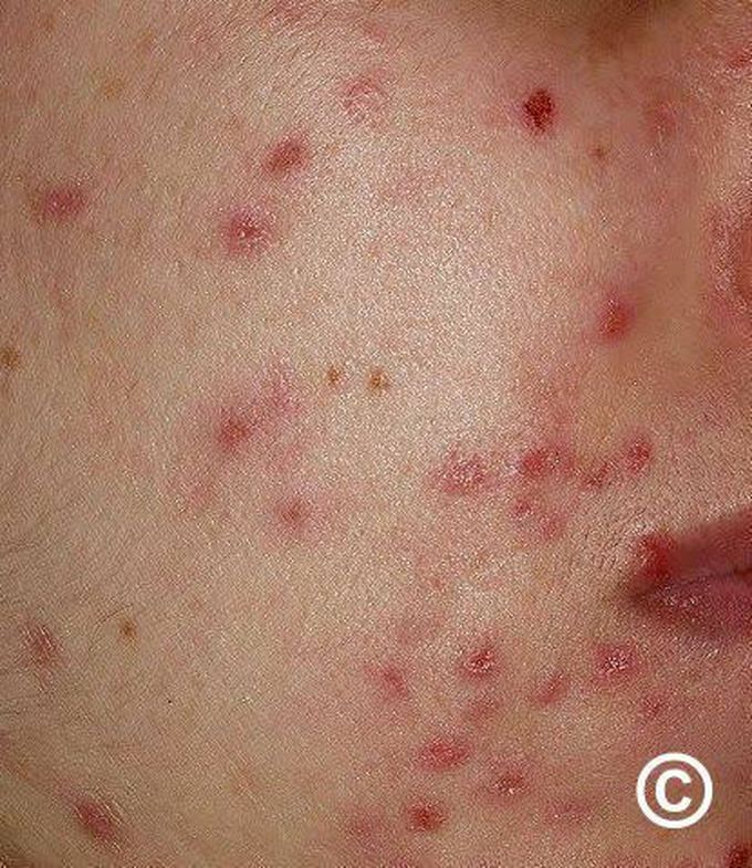 Dermatitis artefacta