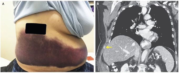 Rib Fracture Associated with Bordetella pertussis Infection