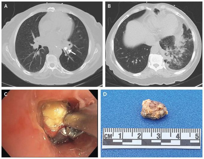 Bronchoscopic Removal of an Obstructing Broncholith
