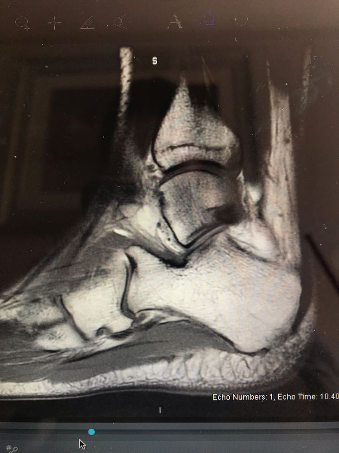 Right ankle mri