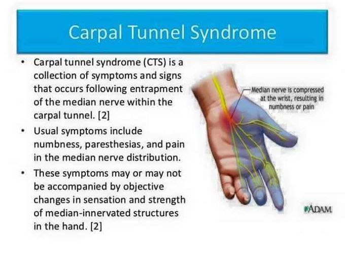 Carpal tunnel syndrome..