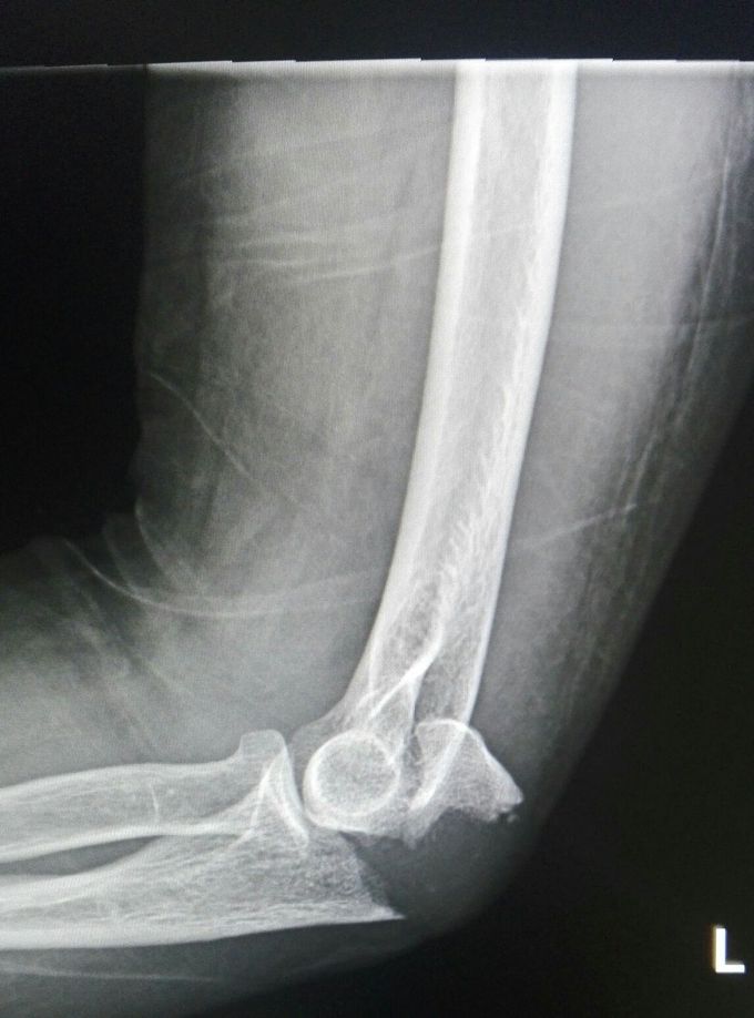 Right elbow lateral View