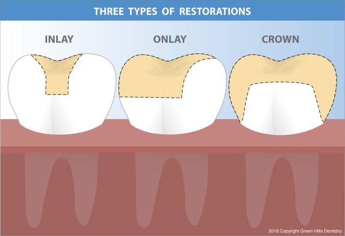 Inlay vs Onlay vs Crown