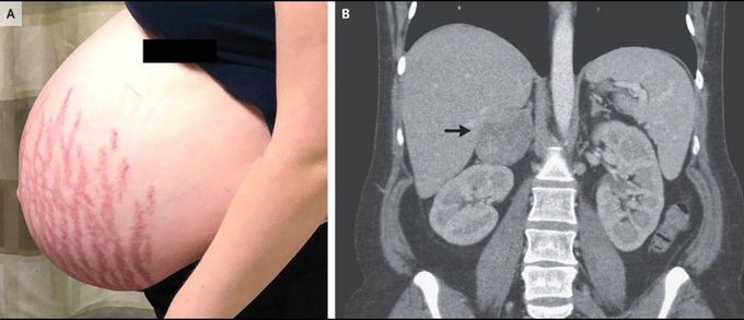 Striae and an Adrenal Mass