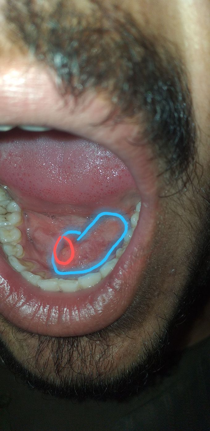  An 25y men was came white Sub lingually glands inflammation the ducts was closed