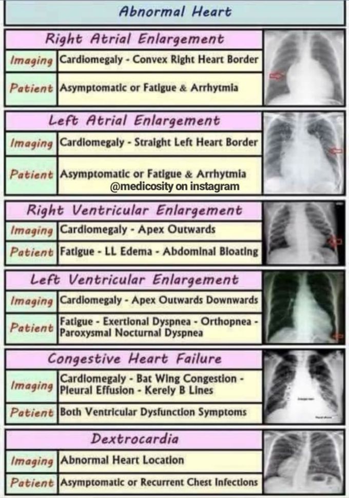 Abnormal Heart