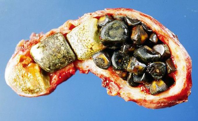 Symptoms of gall stones