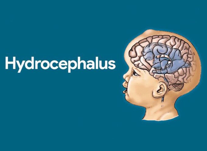 Hydrocephalus