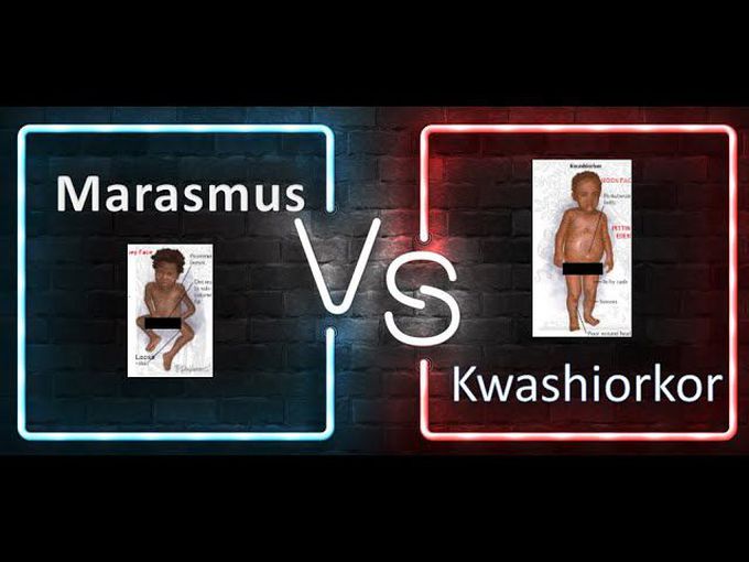 Marasmus vs Kwashiorkor