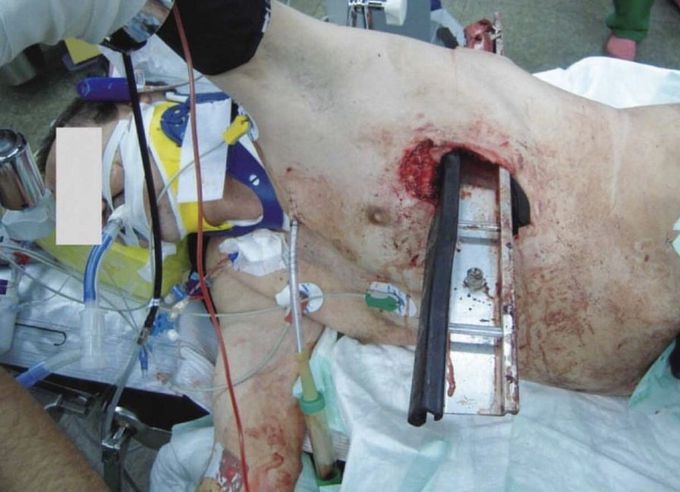 Transthoracic Trauma Impalement