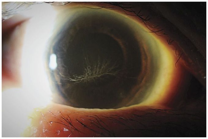 Amiodarone-Induced Vortex Keratopathy