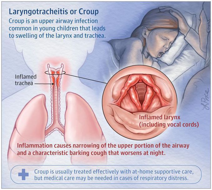 Croup