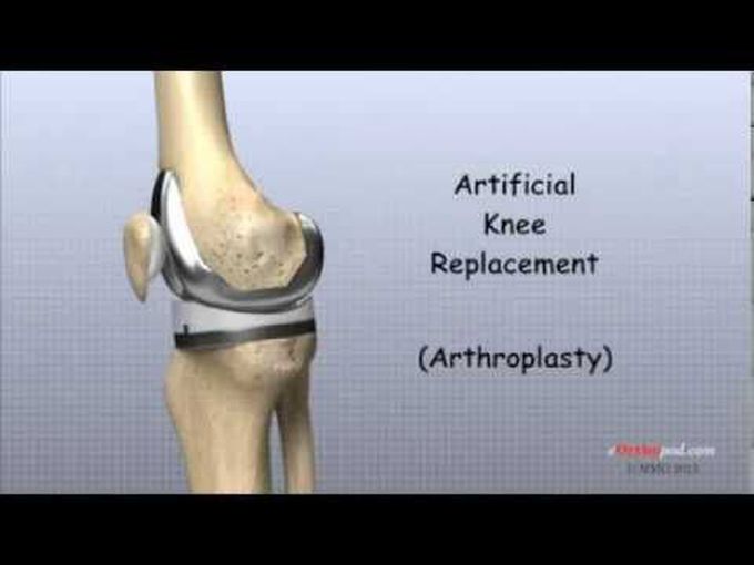 Total Knee Replacement Surgery