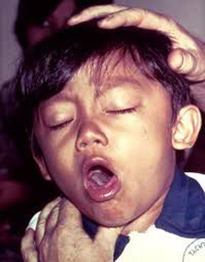 Pertussis (whooping cough)