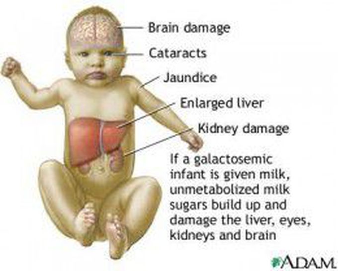 Maple Syrup Urine Disease