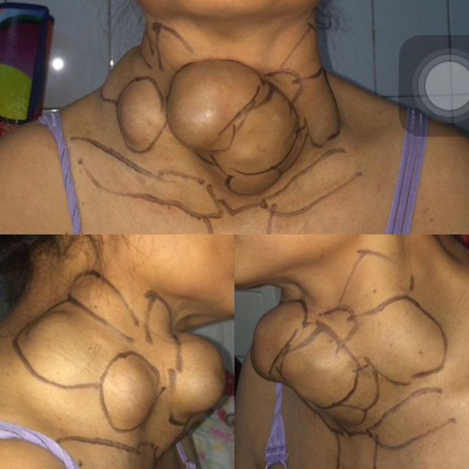 Neck tumor