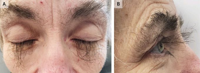 Trichomegaly Associated with Panitumumab