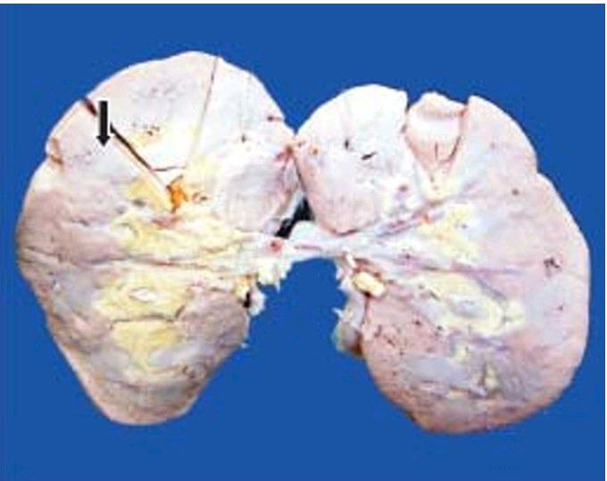 Amyloidosis of kidney.