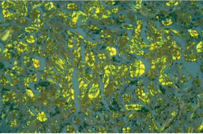 Calcifying Epithelial Odontogenic Tumor.