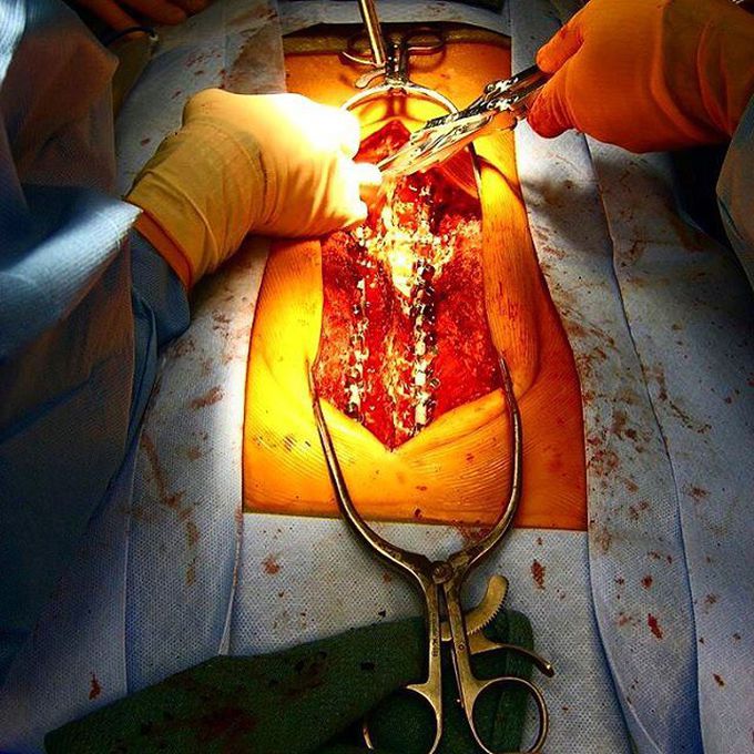 A cool intraoperative picture showing a surgical correction for scoliosis!!! 