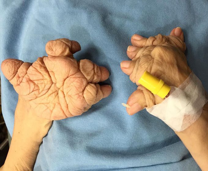 Plummer-Vinson syndrome