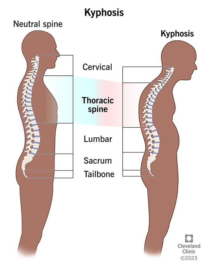Treatment of kyphosis