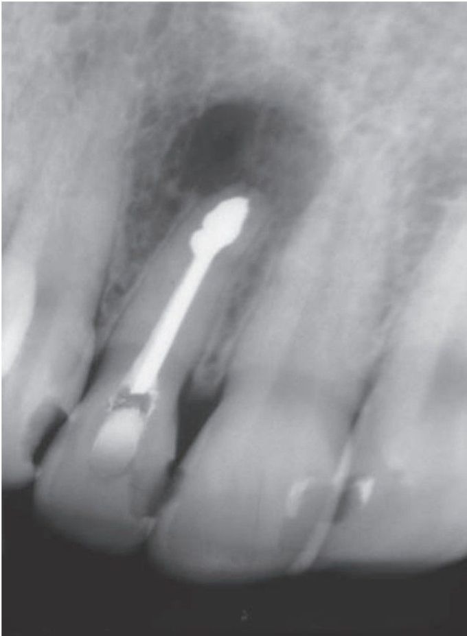 Periapical cyst PA xray