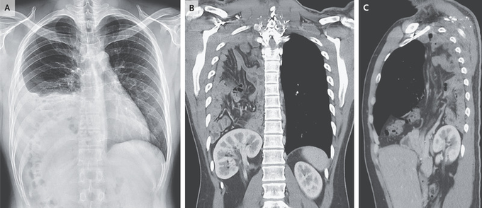 Case of Congenital Diaphragmatic Hernia