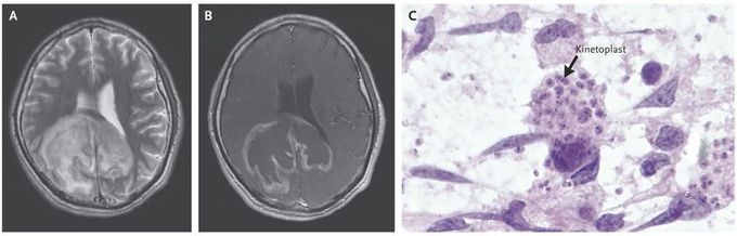 Trypanosoma cruzi Reactivation in the Brain