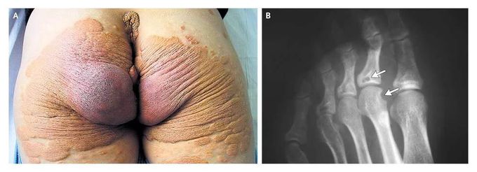 Familial Hypercholesterolemia