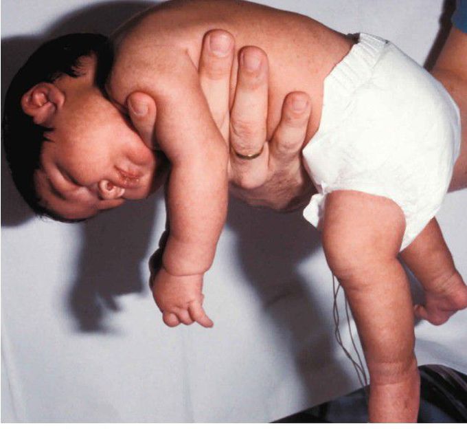 Floppy baby syndrome