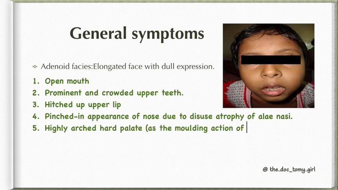 Adenoid Hypertrophy