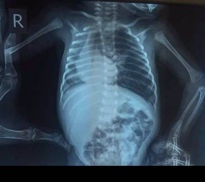 Dextrocardia (Right side heart)