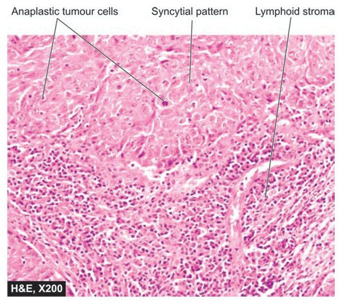 Medullary carcinoma breast